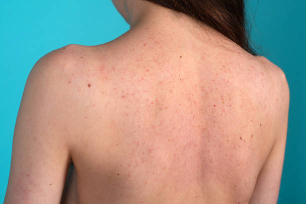istock Young woman with acne, with red spots on the back 1329526262