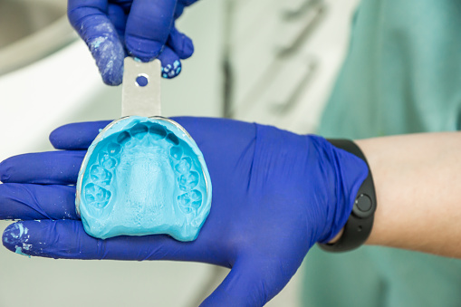 hands with blue latex gloves holding metal mold with blue alginate with dental impression