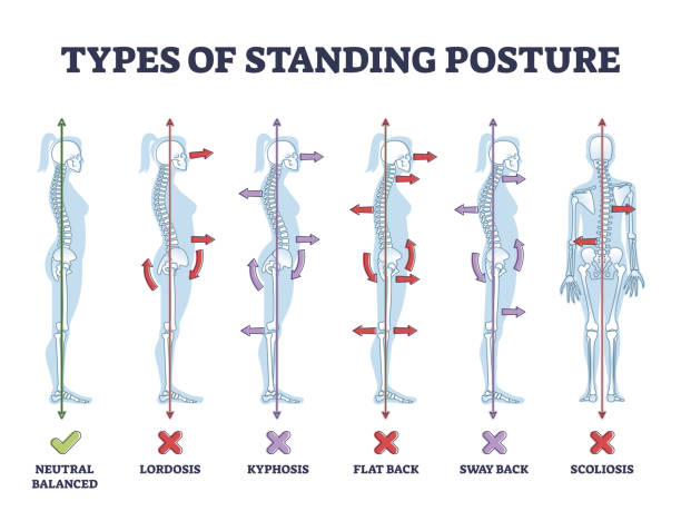 illustrazioni stock, clip art, cartoni animati e icone di tendenza di tipi di posture in piedi e patologia della schiena medica impostare il diagramma di contorno - disfigure