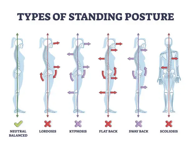 Vector illustration of Types of standing postures and medical back pathology set outline diagram