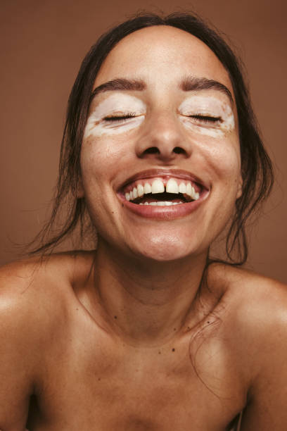 istock Woman embracing her vitiligo 1329696816