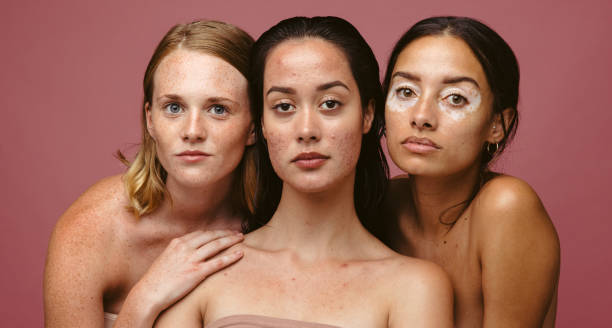 Comfortable in your own skin Close up of women with skin problems together on pink background. Portrait of three confident women with skin disorders. imperfection stock pictures, royalty-free photos & images