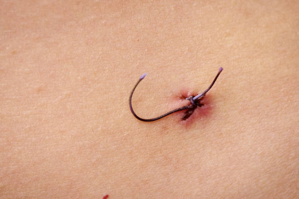 istock Surgical suture on human skin with copy space. 1329717703