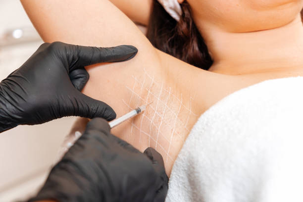 Cosmetologist in black latex gloves makes injection of botulinum toxin on the woman's axillary hollows against hyperhidrosis. Armpit with white drawn grid. Close up Cosmetologist in black latex gloves makes injection of botulinum toxin on the woman's axillary hollows against hyperhidrosis. Armpit with white drawn grid. Close up. sweat gland stock pictures, royalty-free photos & images