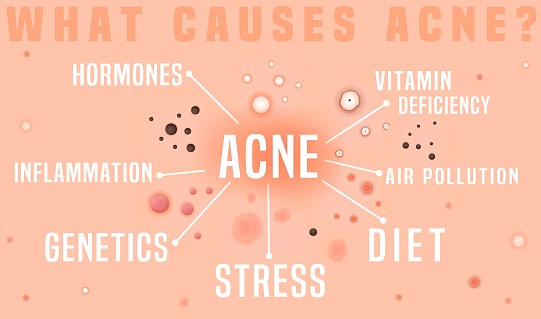 What causes acne poster. Skin disease, dermatology, cosmetology concept.