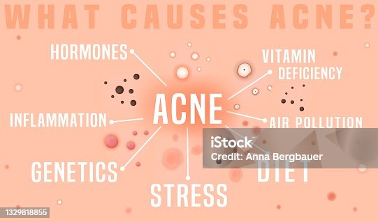 istock What causes acne poster. Skin disease, dermatology, cosmetology concept. 1329818855