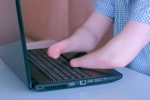 istock Disabled man with amputated two stump hands work typing on laptop closeup view. 1329836978