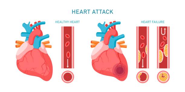 zawał serca i choroby układu krążenia infografika. - cholesterol atherosclerosis human artery illness stock illustrations