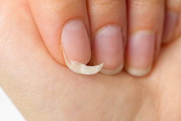 clavo roto en una mano femenina. primer plano de la uña rota. uña quebradiza - nail fotografías e imágenes de stock