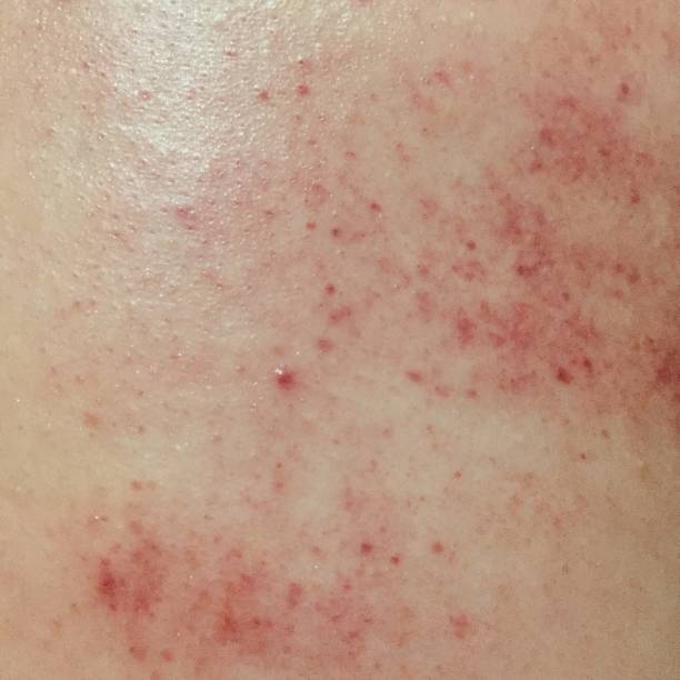 istock Red spots on the back caused by profuse sweating. 1330041803