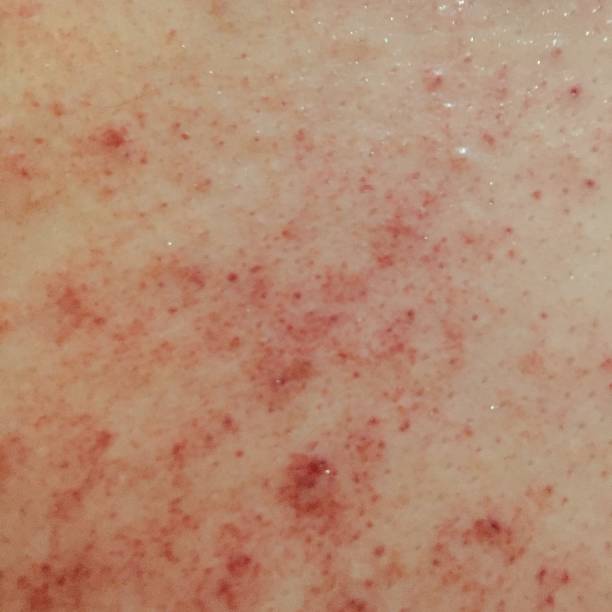 Red And Sweating 50+ Profuse Sweating Stock Photos, Pictures & Royalty-Free Images - iStock