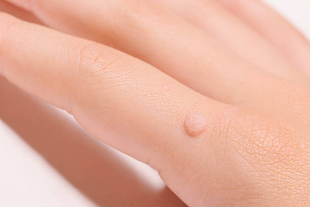 Common wart Verruca vulgaris a flat wart commonly found on the hand of children and adults. They are caused by a type of human papillomavirus HPV. stock photo