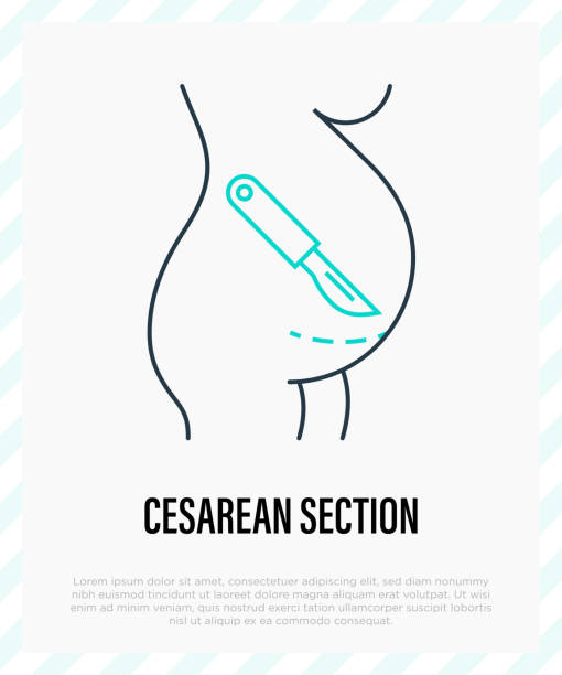 ilustrações, clipart, desenhos animados e ícones de ícone da linha fina da cesariana. bisturi perto da barriga. operação cirúrgica para o parto. ilustração vetorial. - cesarean