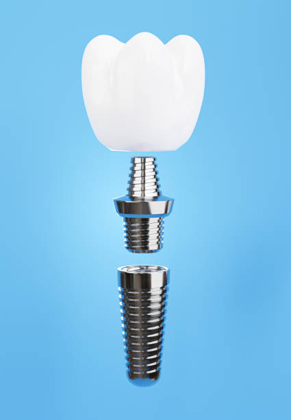 istock dental implant assembly on blue background 1330288734