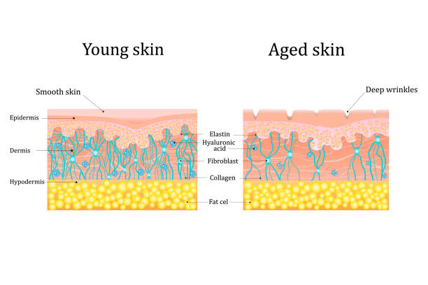 ilustrações, clipart, desenhos animados e ícones de ilustração vetorial de mudanças relacionadas à idade na pele. comparação de pele jovem e velha. estruturar pele humana com colágeno e fibras de elastina, fibroblastos. - casca de fruta