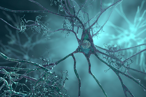 Neurons in dementia. Alzheimer's disease, Huntington's disease. 3D illustration showing amyloid plaques in brain tissue, neurofibrillary tangles and distruction of neuronal networks