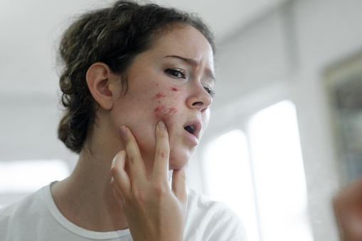 Young woman popping a pimple