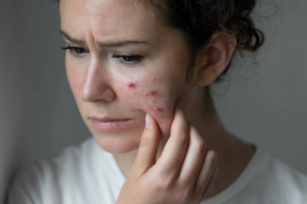 istock Young woman has problems with skin on the face 1330381892