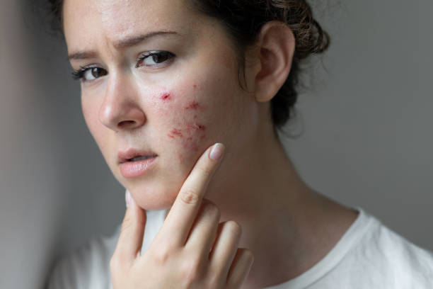 istock Young woman has problems with skin on the face 1330381926