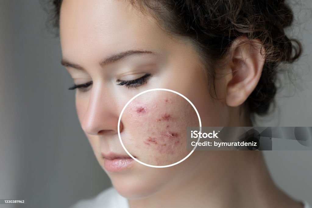 Woman with problem skin Acne Stock Photo