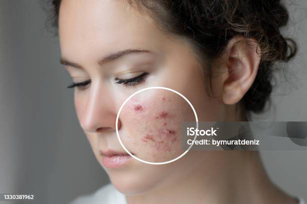 Woman With Problem Skin Stock Photo - Download Image Now - Acne, Pimple, Skin