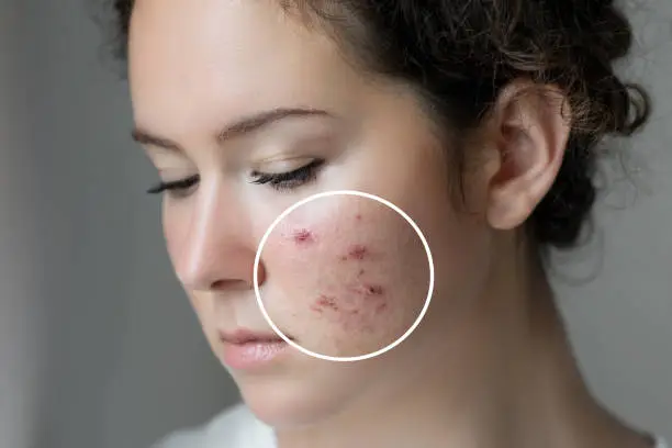 Photo of Woman with problem skin