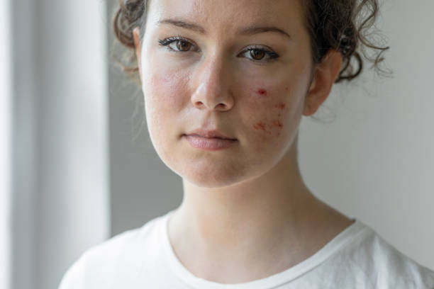 la mujer tiene problemas con la piel de su cara - infame fotografías e imágenes de stock