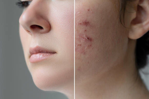 antes y después, cuidado de la piel. - dot gain fotos fotografías e imágenes de stock
