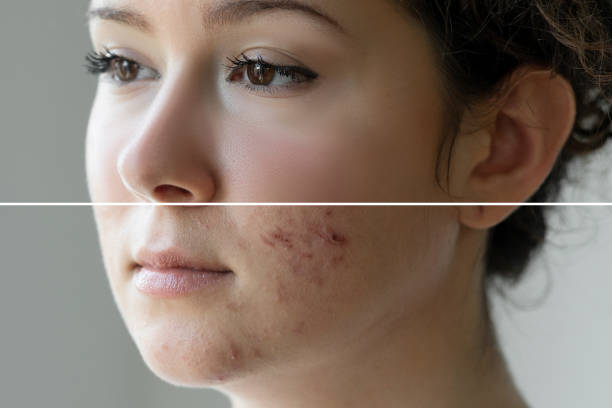 prima e dopo il trattamento per l'acne - dot gain immagine foto e immagini stock