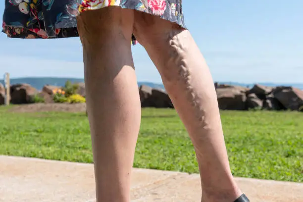 Photo of Varicose veins