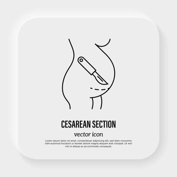 ilustrações, clipart, desenhos animados e ícones de ícone da linha fina da cesariana. bisturi perto da barriga. operação cirúrgica para o parto. ilustração vetorial. - cesarean