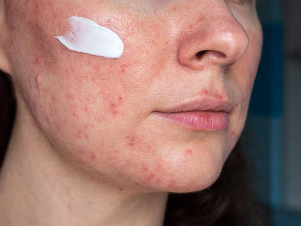 medicated ointment on woman face with rosacea close up - medicated imagens e fotografias de stock