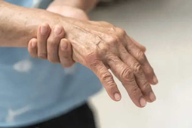 Photo of Guillain-Barre Syndrome GBS, Peripheral Neuropathy pain in elderly patient on hand, fingers, sensory nerves with numb, muscle weakness from chronic inflammatory demyelinating polyneuropathy