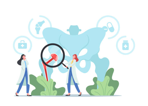Tiny Doctors Characters with Magnifying Glass at Huge Human Pelvic Bones with Total Hip Prosthesis Implant, Arthroplasty Tiny Doctors Characters with Magnifying Glass at Huge Human Pelvic Bones with Total Hip Prosthesis Implant. Arthroplasty, Osteoarthritis, Hip Replacement Concept. Cartoon People Vector Illustration hip replacement stock illustrations