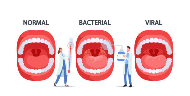 illustrations, cliparts, dessins animés et icônes de personnages de médecins avec thermomètre et spray pour la gorge présentant une infection normale, bactérienne et virale pharyngite - pathogen streptococcus life science