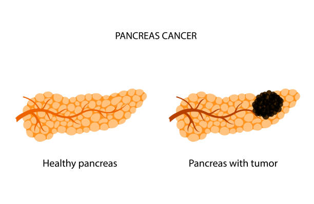 Pancrease Cancer Clip Art 460+ Pancreatic Cancer Cell Stock Illustrations, Royalty-Free Vector ...
