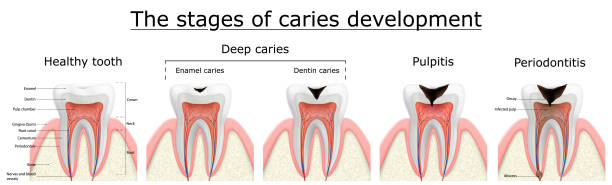 illustrations, cliparts, dessins animés et icônes de étapes de développement de la carie. maladie dentaire: carie, pulpite et parodontite, illustration vectorielle réaliste - dental equipment chair dentist office dentists chair