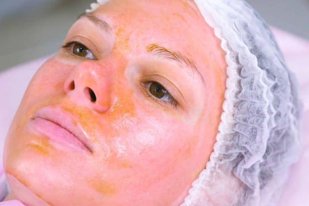 chemical peeling o the woman's face. cleaning the face skin and lightening freckles skin. close-up face. - exfoliating scrub imagens e fotografias de stock