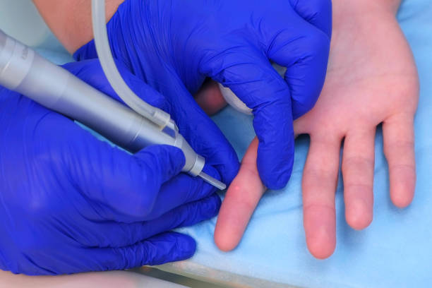 Surgeon operation removing wart on finger using laser beam, hands closeup. Surgeon removing wart on finger using laser, hands closeup. Remove verruca on hand finger. One day surgery concept. Cosmetic treatment. wart stock pictures, royalty-free photos & images