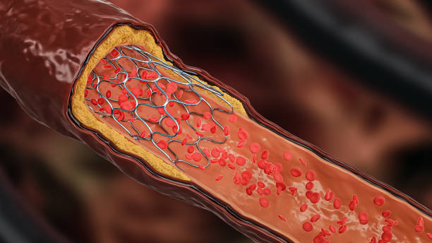 istock Angioplasty 3D rendering illustration. Deployed Stent within a diseased artery or blood vessel clogged by cholesterol or atheroma plaque with blood flow. Surgery, medicine, cardiology, healthcare, technology, science concepts. 1330735791