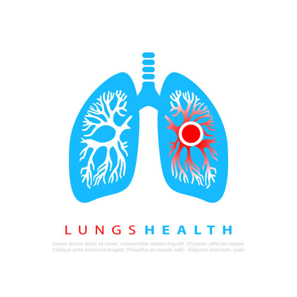 ilustrações, clipart, desenhos animados e ícones de logotipo vetorial médico de infecção pulmonar - adenocarcinoma