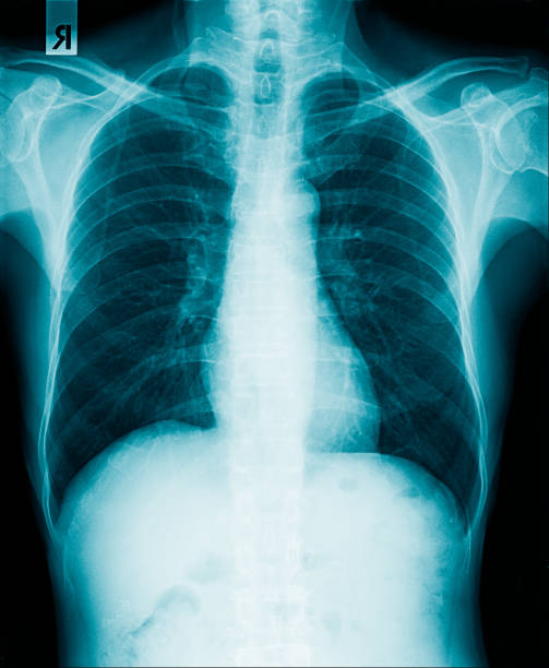 istock chest x-ray image of human 1330744416