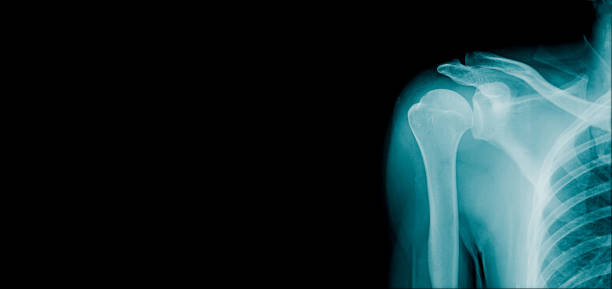 istock banner x-ray image of human shounder 1330744417