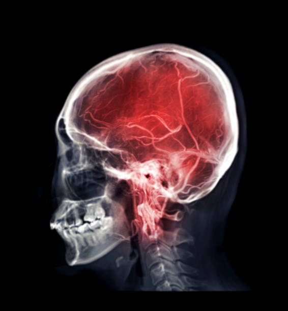 Mix skull image and  MRV Brain or magnetic resonance venography of The Brain for abnormalities in venous drainage of the brain stock photo