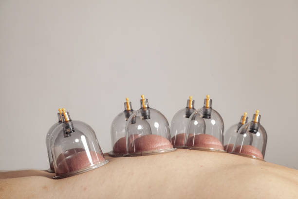 Close-up for multiple vacuum cups, medical cupping therapy Close-up for multiple vacuum cups, medical cupping therapy on human body. Doctor with cups for patient, therapy. Wellness, health injury rehabilitation concept. Alternative medicine. Copy space cupping therapy stock pictures, royalty-free photos & images