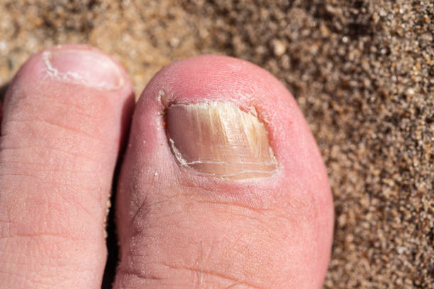 Fungus on the toenail of a man's toe, close-up on the sand Fungus on the toenail of a man's toe, close-up on the sand bed of nails stock pictures, royalty-free photos & images