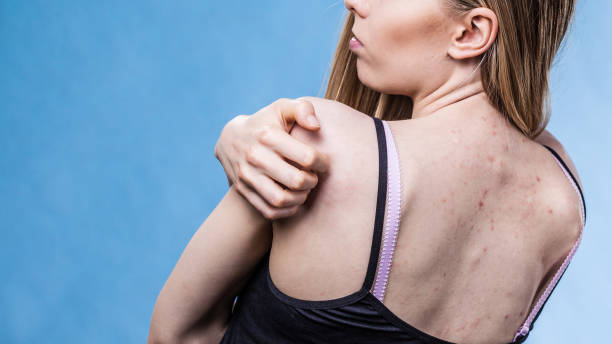istock Woman with skin problem acne on back 1330872864