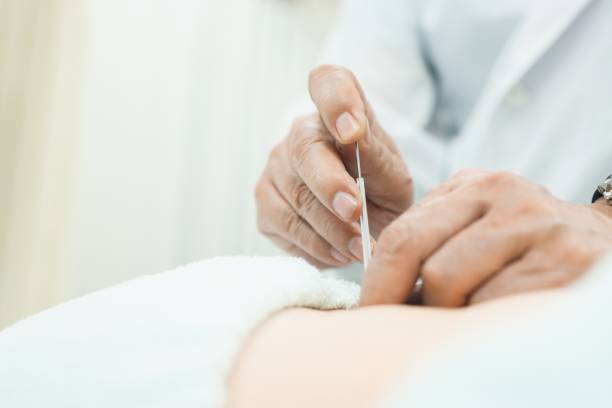 Body acupuncture as Alternative Medicine Closeup to Acupuncture for the treatment of the lower back acupuncture model stock pictures, royalty-free photos & images