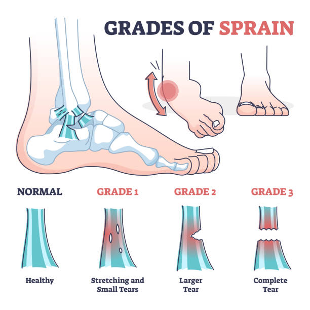 ilustrações de stock, clip art, desenhos animados e ícones de grades of sprain as ankle or foot medical injury levels outline diagram - sprain