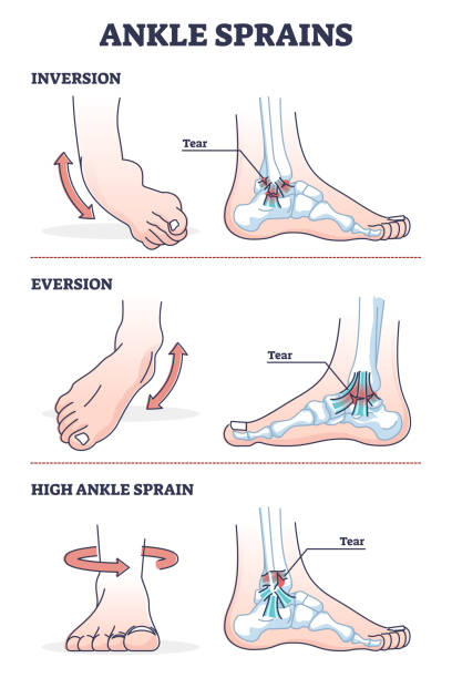 illustrazioni stock, clip art, cartoni animati e icone di tendenza di situazioni di distorsione della caviglia con diagramma di profilo dell'inversione e dell'eversione - twisted ankle immagine